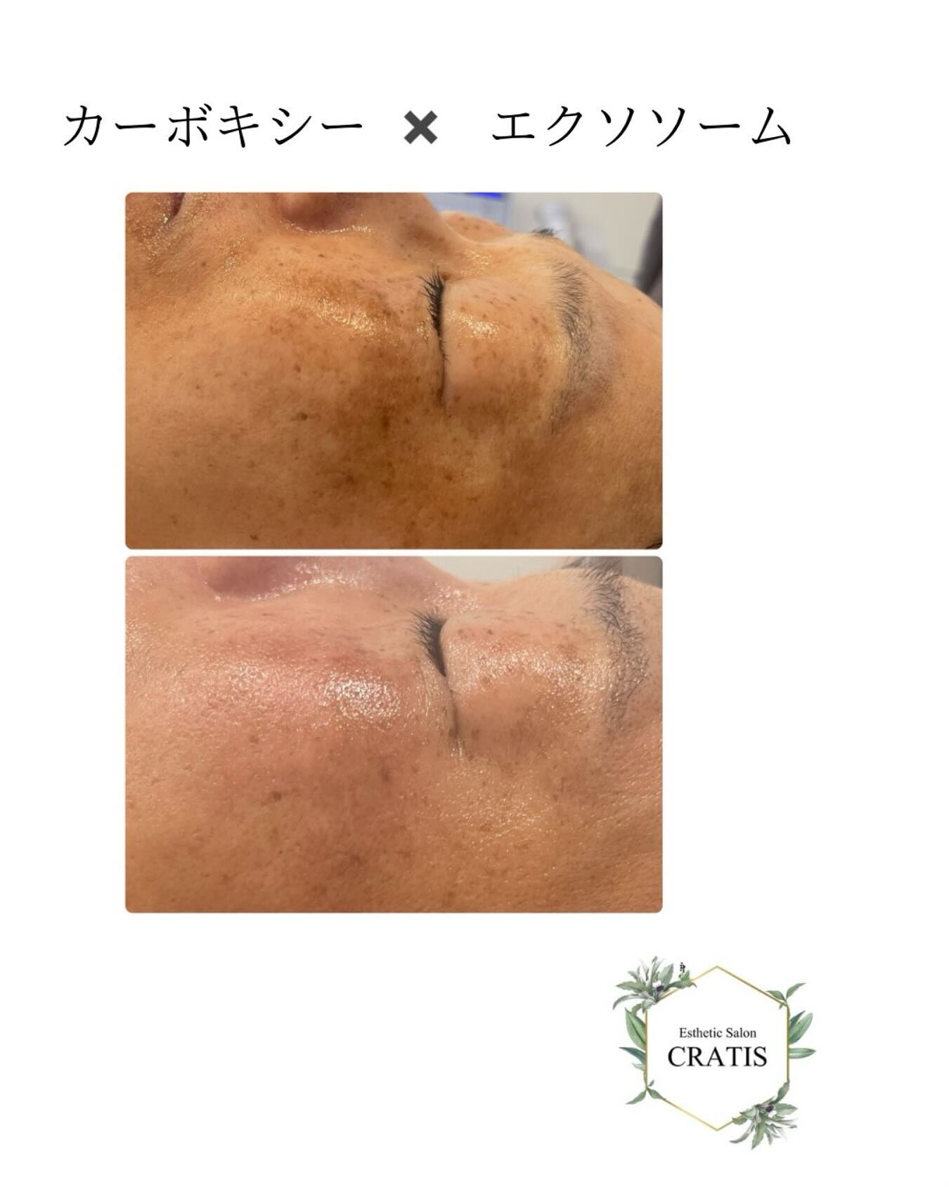 カーボキシー✖️エクソソームで本気のエイジングケア