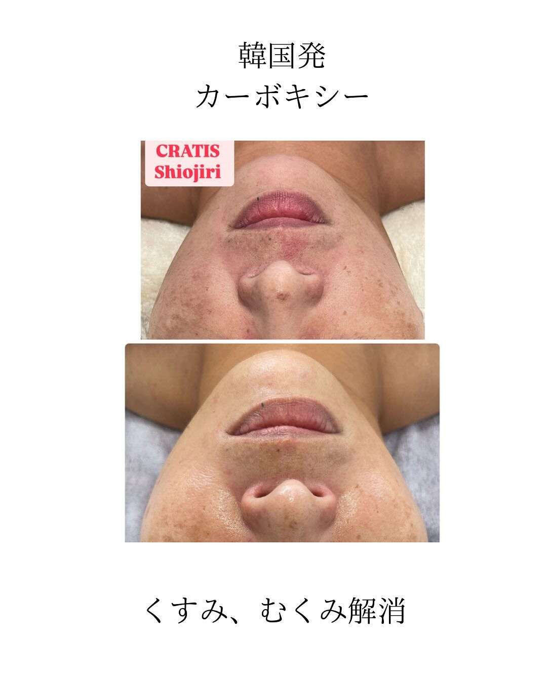 カーボキシーでくすみ解消して明るい春肌へ！