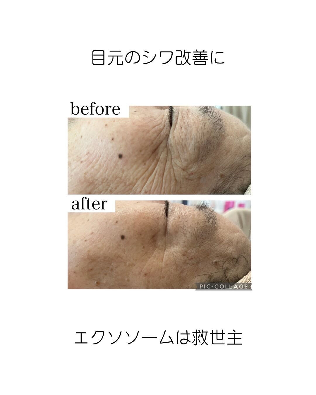 今話題のエクソソーム導入❣️