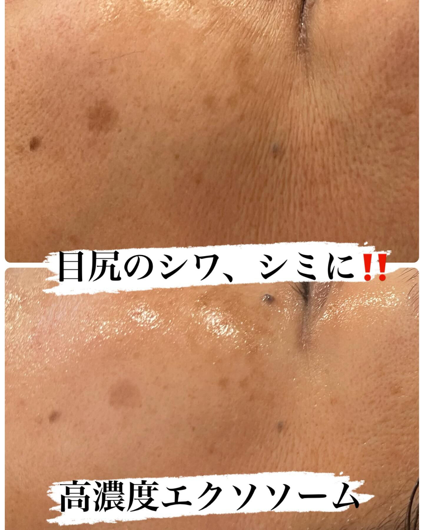 【春の集中ケア】毛穴洗浄 × カーボキシー × 高濃度エクソ