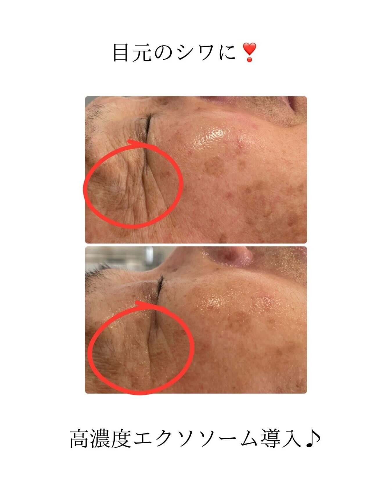 【話題沸騰！高濃度エクソソーム導入】