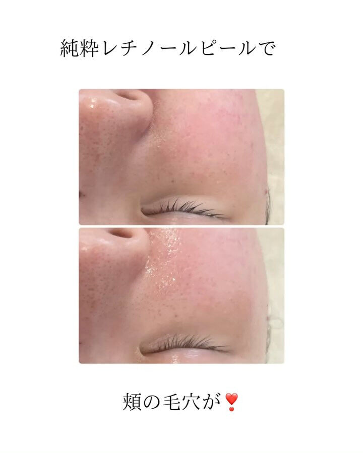 ＼肌革命、始まる／