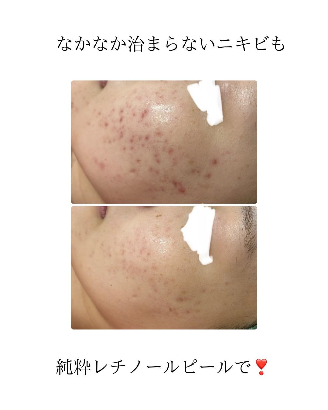 ＼肌革命、始まる／
