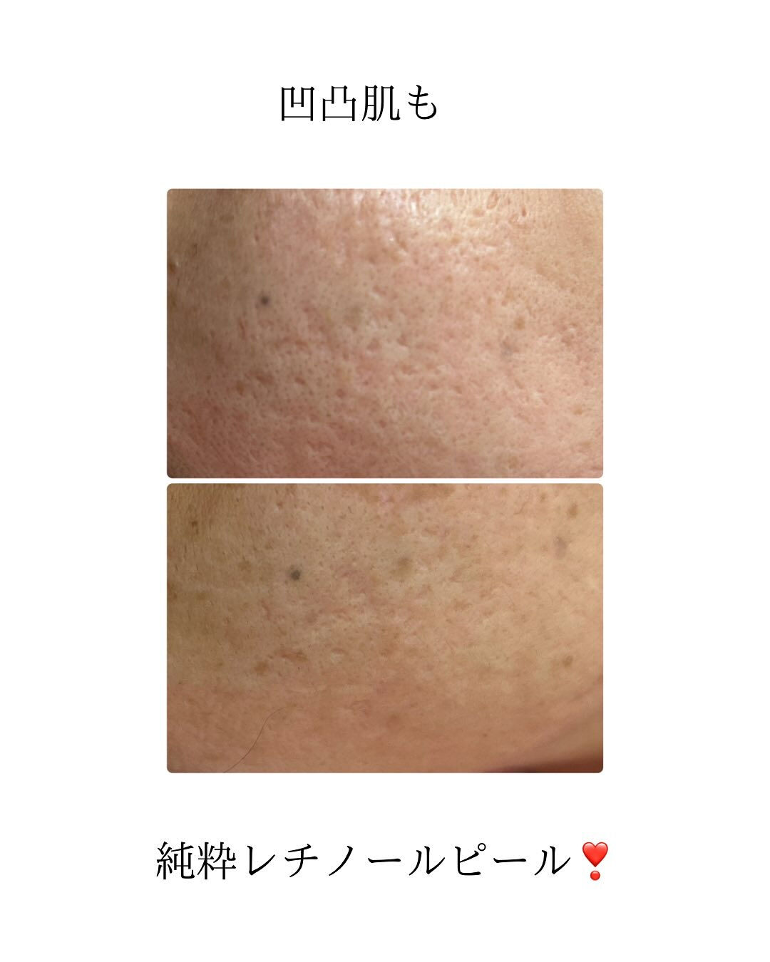 ＼肌革命、始まる／