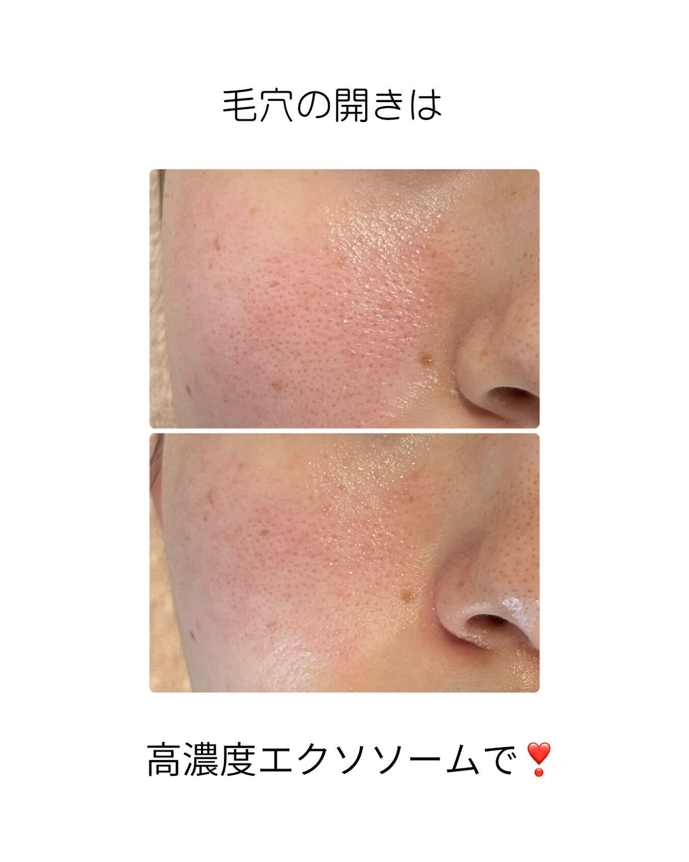 お肌の未来を変える最新ケア「エクソソーム」✨