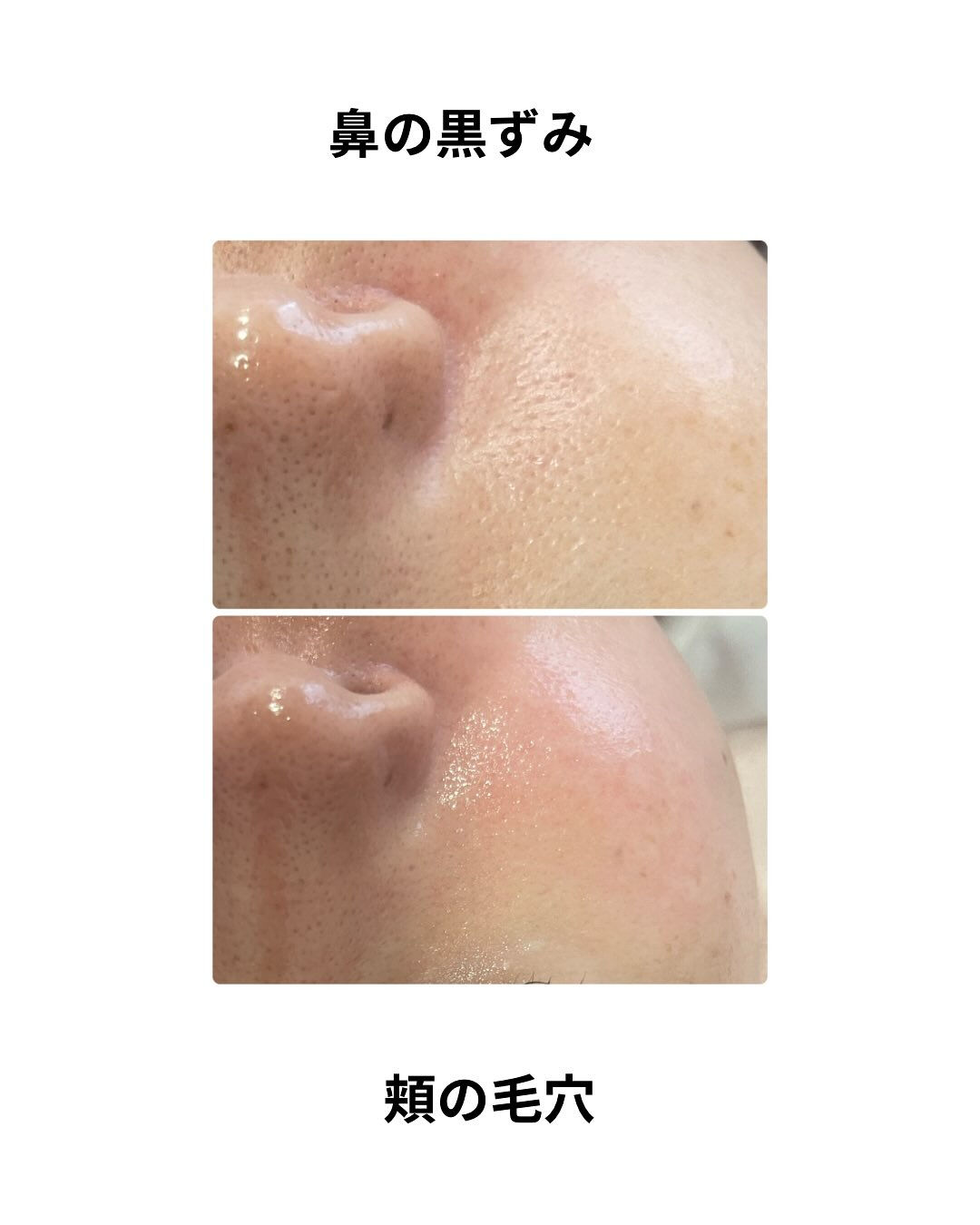 フェイスWax &エクソソーム導入✨