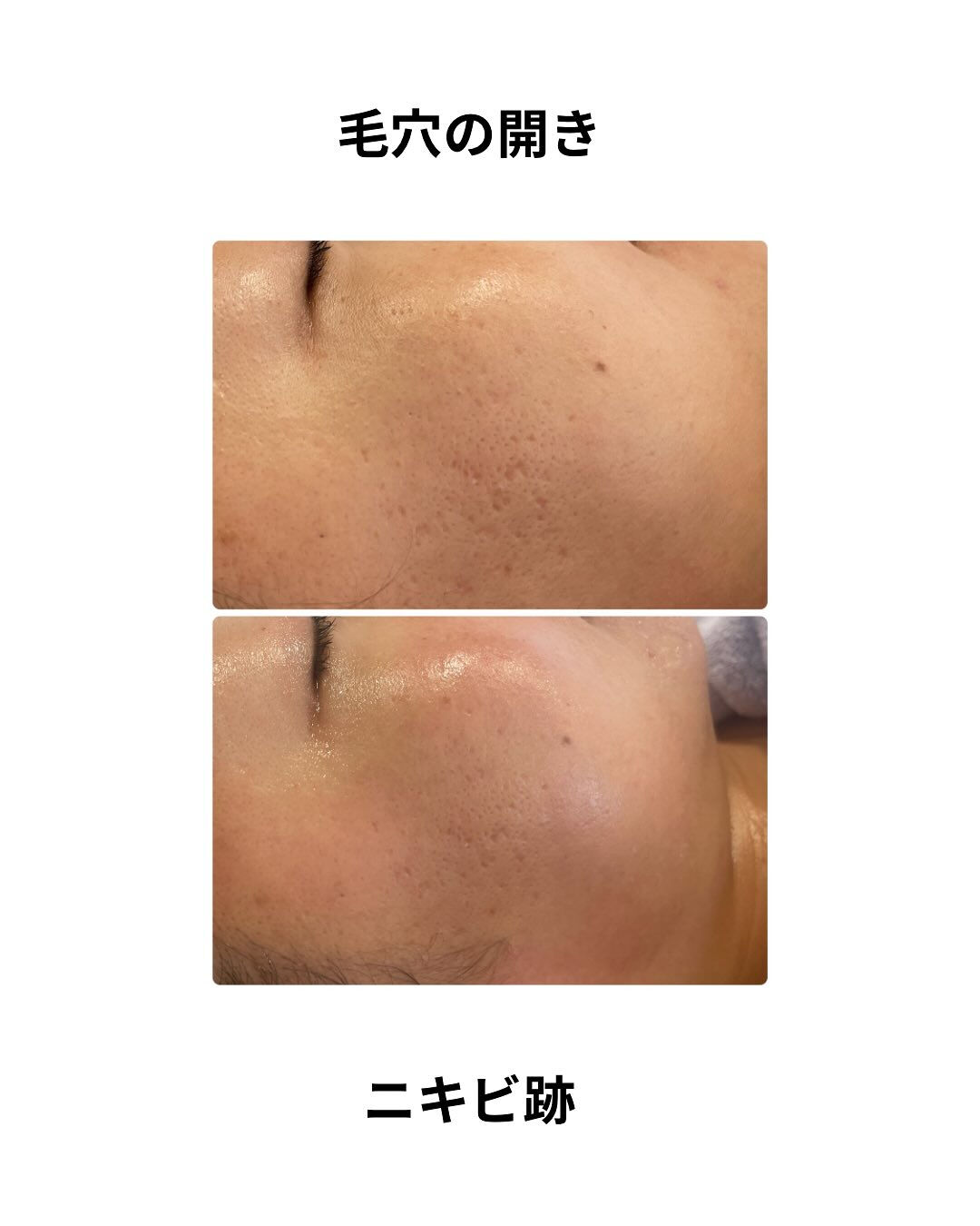 フェイスWax &エクソソーム導入✨