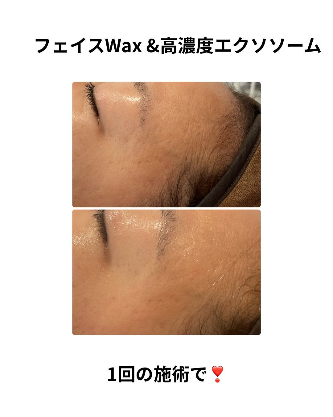 フェイスWax &エクソソーム導入✨