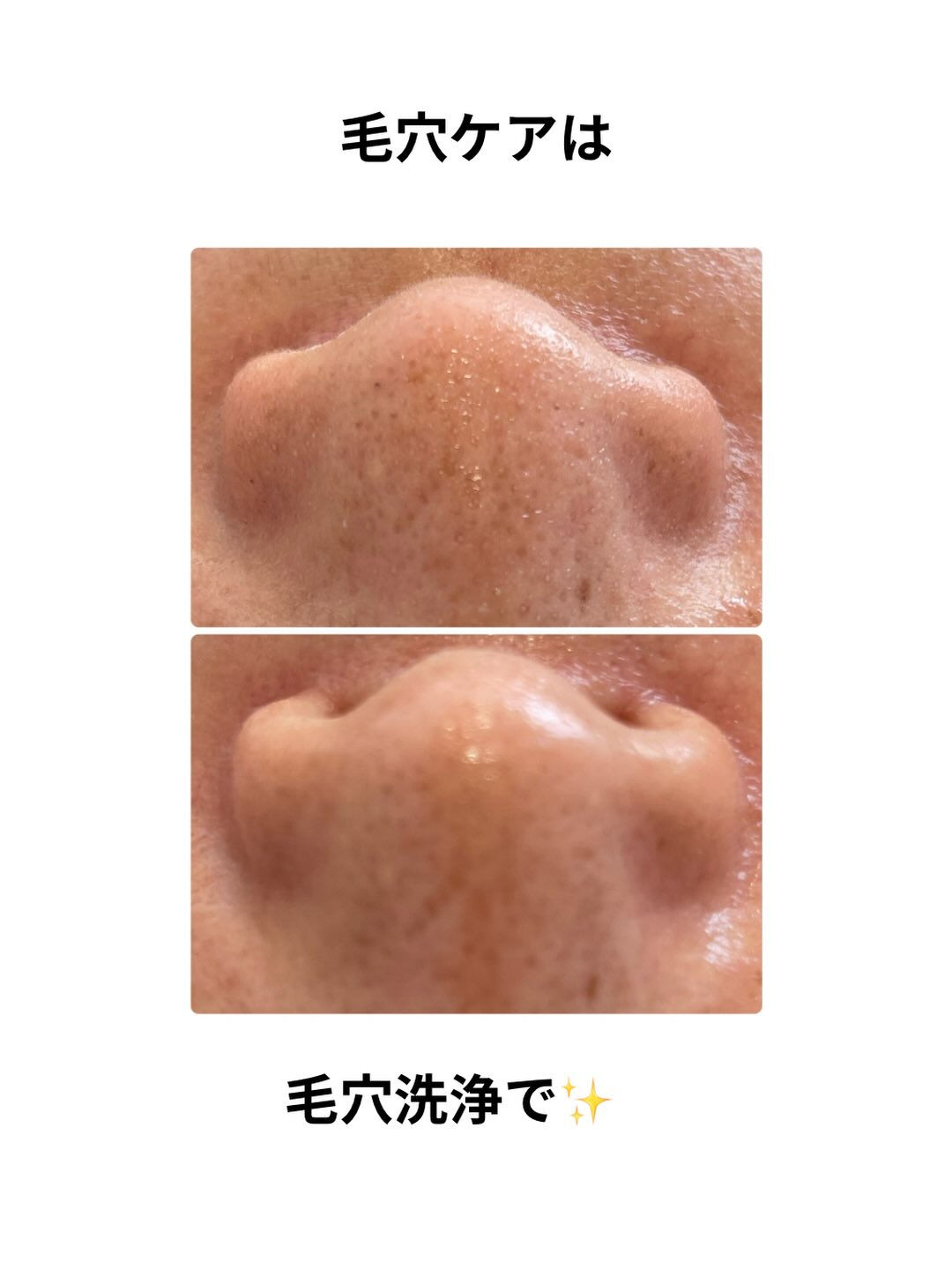 スキンケアは毛穴洗浄から始めましょう〜